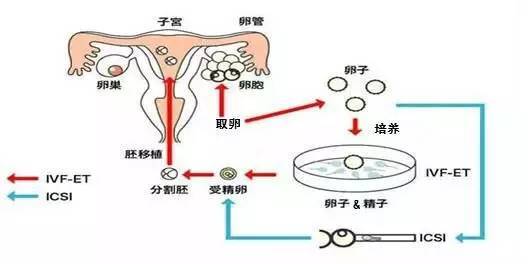第三代试管婴儿