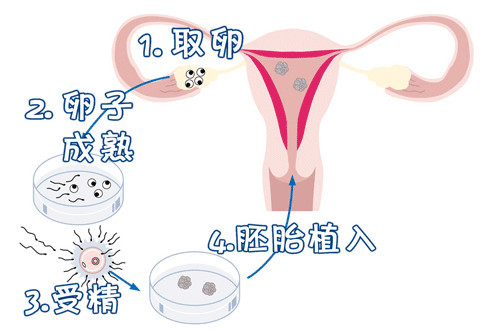 无痛试管婴儿